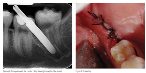 Implant Ce Article Atraumatic Extraction Of Mandibular Third Molars