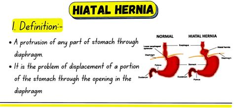 Solution Medical Surgical Nursing Notes Hiatal Hernia Studypool