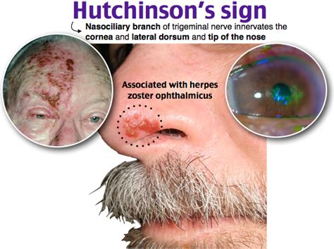 Herpes zoster ophthalmicus (hzo), a potentially devastating form of acute herpes zoster, results from the reactivation of vzv in the trigeminal (fifth cranial) nerve. Pin on third year.....