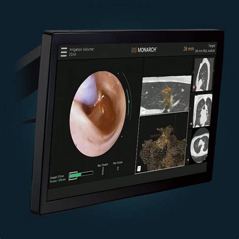 Monarch™ Platform For Peripheral Lung Biopsy Jandj Medtech