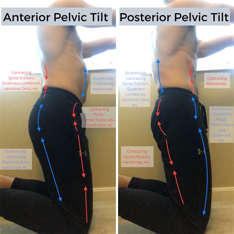 Anterior Pelvic Tilt And How To Remedy Progress Posture