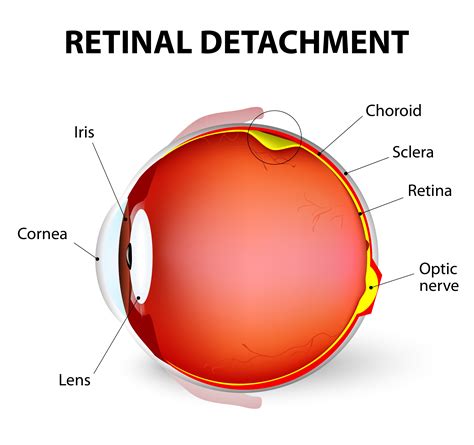 Retinal Detachment Surgery Vitrectomy Rs