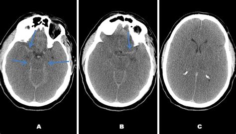 Pseudo Subarachnoid Hemorrhage Due To Diffuse Cerebral Edema