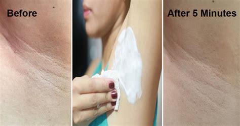Along with excess body hair, other symptoms of pcos include: Home Remedies To Lighten Up Your Dark Underarms! - Handy DIY