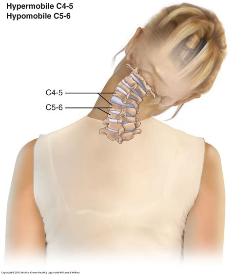 Joint Dysfunction Subluxation Misalignment Of The Cervical Spine