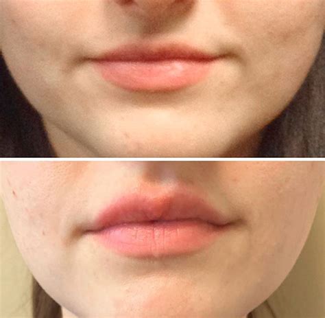 Juvederm Ultra Plus Before And After Lips
