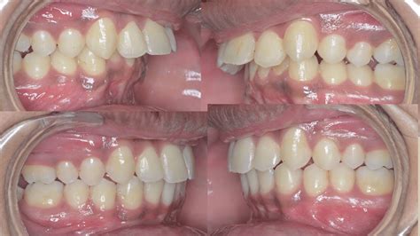 Overbite Teeth And Buck Teeth Correctionadult Bracesbraces Before After Youtube