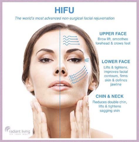 Hifu The Worlds Most Advanced Non Surgical Face Lift At Radiant Living