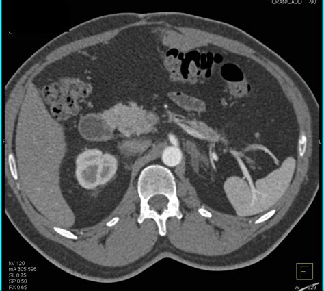 Left Adrenal Hyperplasia Adrenal Case Studies Ctisus Ct Scanning