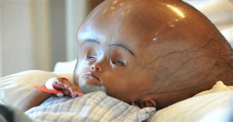 Toddler Whose Head Doubled In Size On The Road To Amazing Recovery
