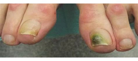 Discover More Than 112 Green Bacteria On Nails Best Vn