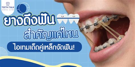 ยางดึงฟันสำคัญแค่ไหน ไอเทมเด็ดคู่เหล็กจัดฟัน Sowon Clinic