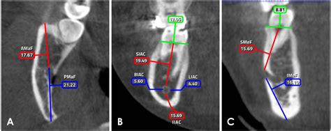 Sex Determination By Radiographic Localization Of The Inferior Alveolar
