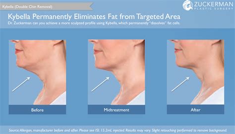 Kybella Injections Double Chin Removal Treatment Nyc Top Ranked