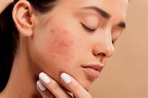 Acne Treatment Mumbai Pimples Acne Scars Clinics Cost India The
