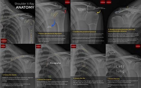 Shoulder X Ray Interpretation Checklist 1 Assess Glenohumeral