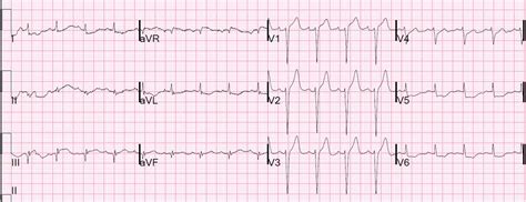Dr Smiths Ecg Blog Is It Stemi Or Non Stemi What You Call It Has
