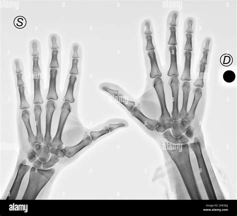 Radiografía De Las Manos Con Artritis En Los Pulgares Fotografía De