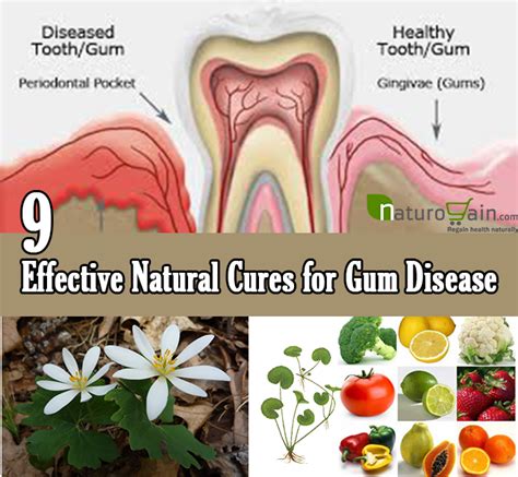 Dec 03, 2020 · the homemade mouth wash solution you posted above is a clever way to prevent periodontal disease. 9 Effective Natural Cures for Gum Disease - Treat Gum ...