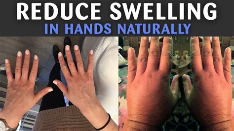 How To Reduce Swelling In Hands Naturally How To Reduce Swelling In