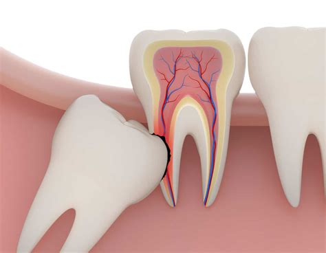 Wisdom Tooth Extraction Miami Fl Dentist Brickell Dental General Dentist