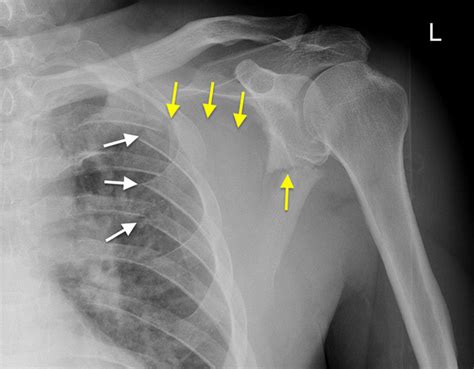 Fractured Collarbone Surgery Surgery For Clavicle Fracture Broken