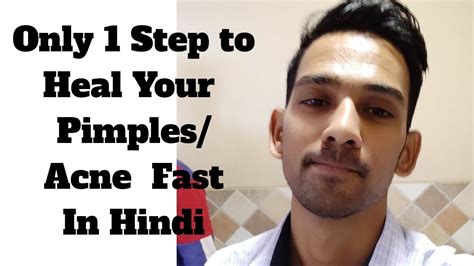 Your wound will heal faster if you follow all the standard operating procedures such as proper dressing, medication, changing your bandage regularly. How to heal your Pimples/Acne Fast - YouTube