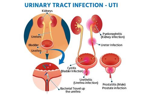Urinary Tract Infection Symptoms Causes Risks And Diagnosis
