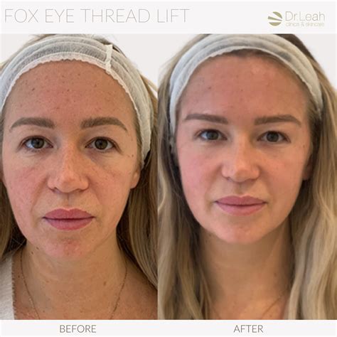 The Thread Lift The Trending Treatment Taking On The Surgical Face