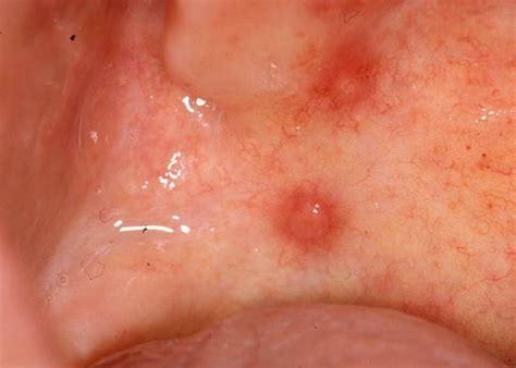 Questions about bumps in mouths are very common ones so he and his team put together a list of the 12 most common causes, symptoms and a guideline to while many bumps on the roof of the mouth will resolve without treatment, some may require medical intervention. Current Health ArticlesBump on the Roof of Mouth - Causes ...
