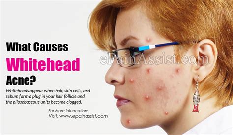 What Causes Whitehead Acne And How To Get Rid Of It