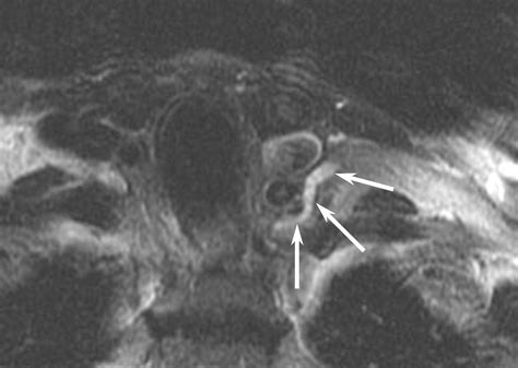 Normal Ct Appearance Of The Distal Thoracic Duct Ajr