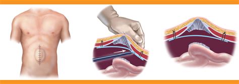 The characteristics of the ideal material for repair of the abdominal wall fascial defects should include strength. Laparoscopic Ventral Hernia Repair Information from SAGES