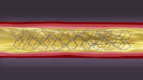 Another Bioresorbable Stent Hits A Snag Medpage Today
