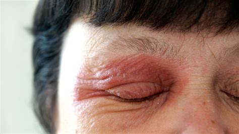 Eczema Eye Complications How To Protect Your Vision