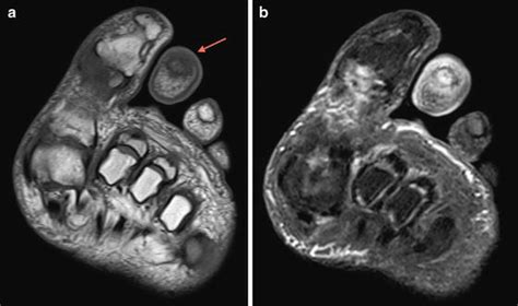 Diagnostic Imaging Of Osteomyelitis Of The Foot And Ankle