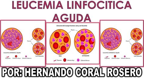 These symptoms occur due to a lack of normal blood cells. LEUCEMIA LINFOCITICA AGUDA PDF