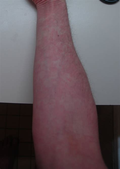 Rash On Forearms Only Pictures Photos