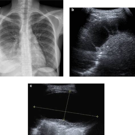In our study loculated pleural effusion were seen in 8 patients, among which 6 cases were loculated tubercular effusion which were treated with steroids and 2 cases were loculated empyema of which. Loculated Pleural Effusion X Ray - Pleural Effusion : So ...
