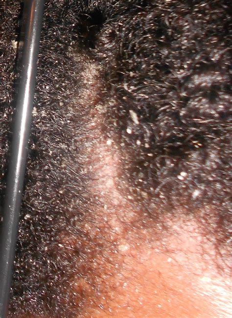 Scalp Fungus Pictures Pictures Photos