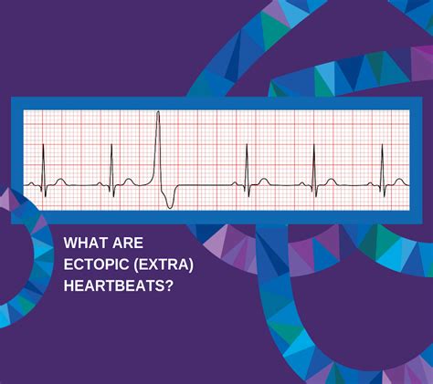 What Are Ectopic Heartbeats Connected Cardiology Dr Jennifer Coller