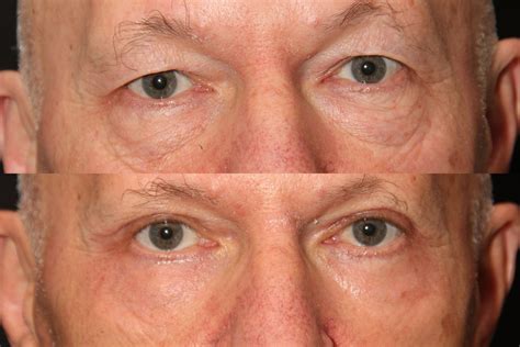 Eyelid Surgery Blepharoplasty Toronto Solomon Facial Plastic