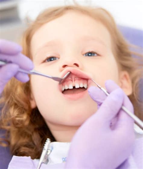 Lip And Tongue Tie Papillion Ne Frenectomy Surfs Up Pediatric Dentistry