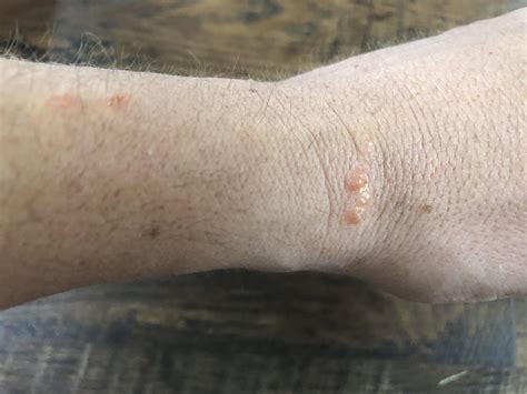 Quite itchy bumps on wrist/arm, new ones appear daily. Any ideas on