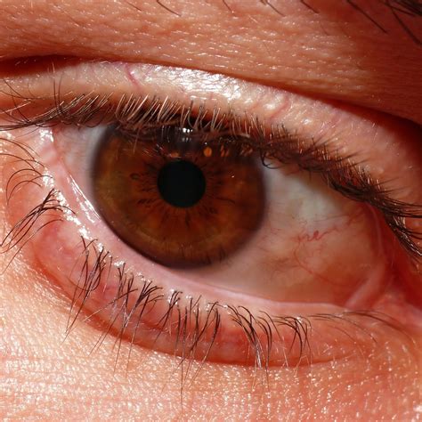 Red Eyes May Be A Tell Tale Sign Of Coronavirus Doctor Bob