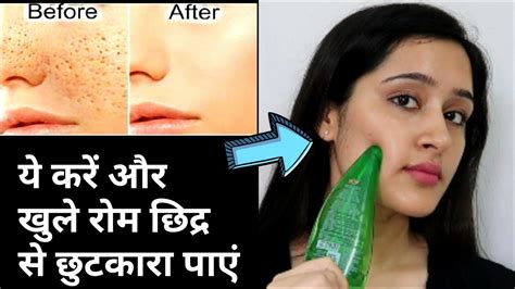 How To Get Rid Of Open Pores In 1 Minute Open Pores Removal Remedy