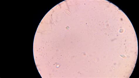 Canker Trichomonas Under Microscope Youtube