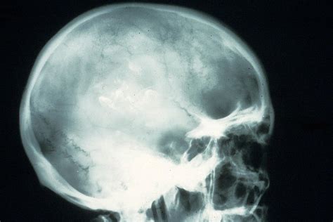 Brain Cancer Skull Cancerwalls