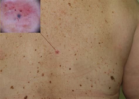 Early Signs Of Skin Cancer Skin Cancer Skin Cancer Pictures Moles