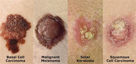 What Are The Different Types Of Skin Cancer Everyday Health Vlrengbr